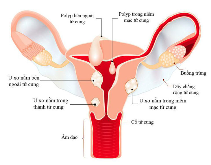 U xơ tử cung: Dấu hiệu, triệu chứng và biến chứng